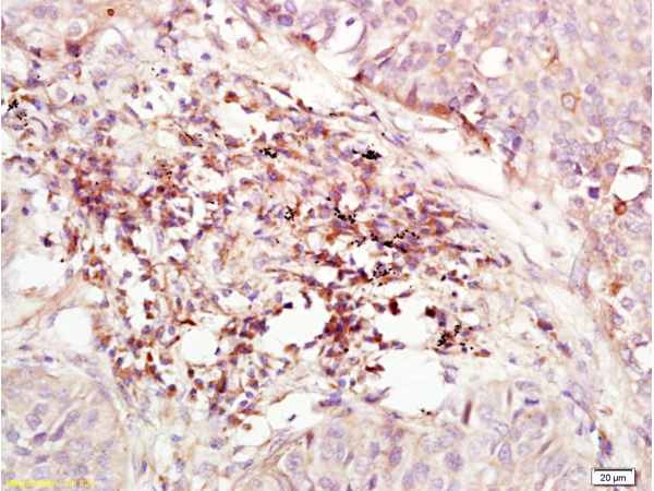 Formalin-fixed and paraffin embedded human lung carcinoma labeled with Anti-CD184\/CXCR4 Polyclonal Antibody (bs-1011R), Unconjugated at 1:200, followed by conjugation to the secondary antibody and DAB staining