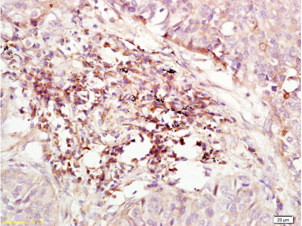 Formalin-fixed and paraffin embedded human lung carcinoma labeled with Anti-CD184/CXCR4 Polyclonal Antibody (bs-1011R), Unconjugated at 1:200, followed by conjugation to the secondary antibody and DAB staining