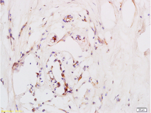 Formalin-fixed and paraffin embedded human breast carcinoma labeled with Anti-CD184/CXCR4 Polyclonal Antibody (bs-1011R), Unconjugated at 1:200, followed by conjugation to the secondary antibody and DAB staining