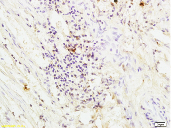 Formalin-fixed and paraffin embedded human colon carcinoma labeled with Anti-PAR-1 Polyclonal Antibody (bs-0828R), Unconjugated at 1:200, followed by conjugation to the secondary antibody and DAB staining