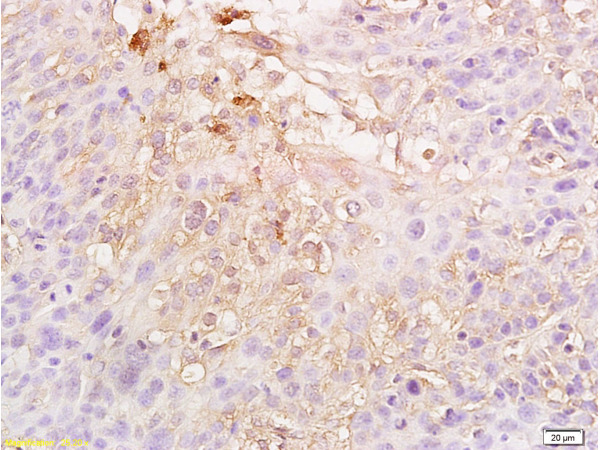 Formalin-fixed and paraffin embedded human cervical carcinoma labeled Anti-HIF-1-Alpha Polyclonal Antibody (bs-0737R), Unconjugated  at 1:300, followed by conjugation to the secondary antibody and DAB staining
