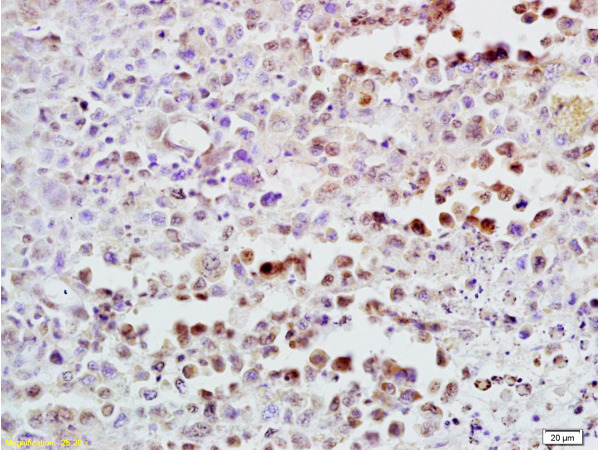 Formalin-fixed and paraffin embedded mouse lymphoma tissue labeled with Anti-CDK4 Polyclonal Antibody (bs-0633R), Unconjugated  at 1:300, followed by conjugation to the secondary antibody and DAB staining