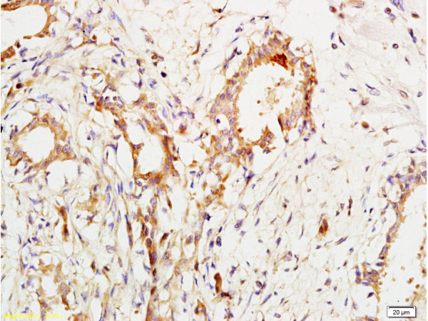Formalin-fixed and paraffin embedded human breast cancer labeled with Anti-CA153/MUC1/KL-6 Polyclonal Antibody, Unconjugated (bs-1497R) at 1:200 followed by conjugation to the secondary antibody and DAB staining.