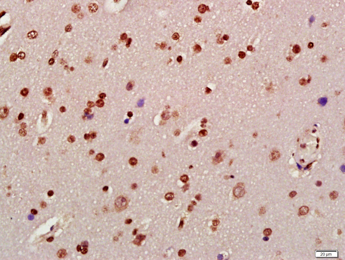 Paraformaldehyde-fixed, paraffin embedded Human brain glioma; Antigen retrieval by boiling in sodium citrate buffer (pH6.0) for 15min; Block endogenous peroxidase by 3% hydrogen peroxide for 20 minutes; Blocking buffer (normal goat serum) at 37°C for 30min; Antibody incubation with Alpha synuclein (Tyr125) Polyclonal Antibody, Unconjugated (bs-5627R) at 1:400 overnight at 4°C, DAB staining. Paraformaldehyde-fixed, paraffin embedded Human brain glioma; Antigen retrieval by boiling in sodium citrate buffer (pH6.0) for 15min; Block endogenous peroxidase by 3% hydrogen peroxide for 20 minutes; Blocking buffer (normal goat serum) at 37°C for 30min; Antibody incubation with Alpha synuclein (Tyr125) Polyclonal Antibody, Unconjugated (bs-5627R) at 1:400 overnight at 4°C, DAB staining.
