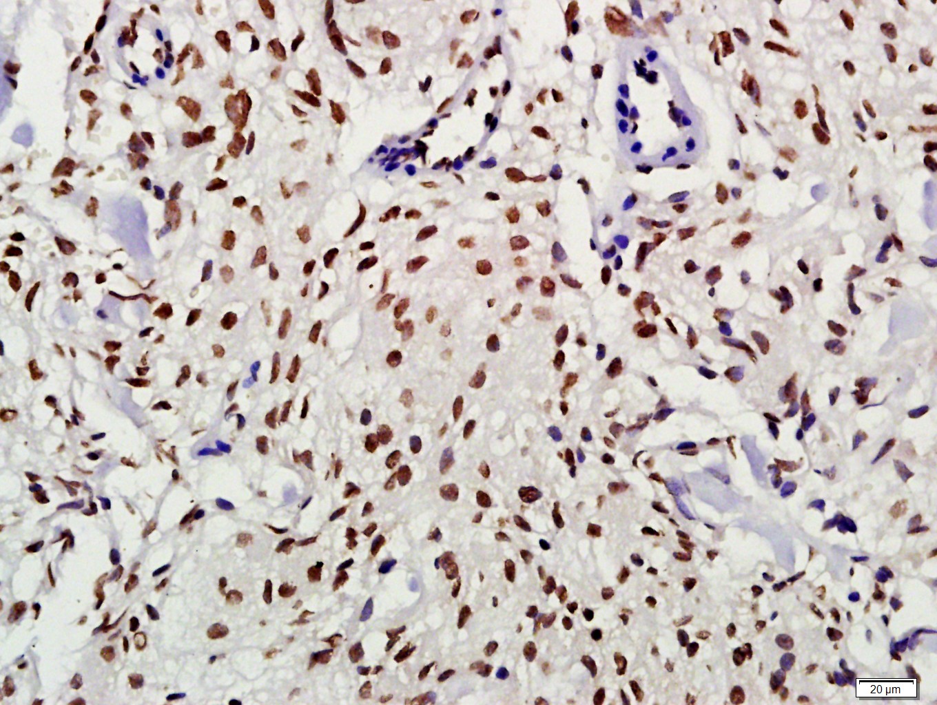 Paraformaldehyde-fixed, paraffin embedded Human meningiomas; Antigen retrieval by boiling in sodium citrate buffer (pH6.0) for 15min; Block endogenous peroxidase by 3% hydrogen peroxide for 20 minutes; Blocking buffer (normal goat serum) at 37°C for 30min; Antibody incubation with Alpha synuclein (Tyr125) Polyclonal Antibody, Unconjugated (bs-5627R) at 1:400 overnight at 4°C, DAB staining.