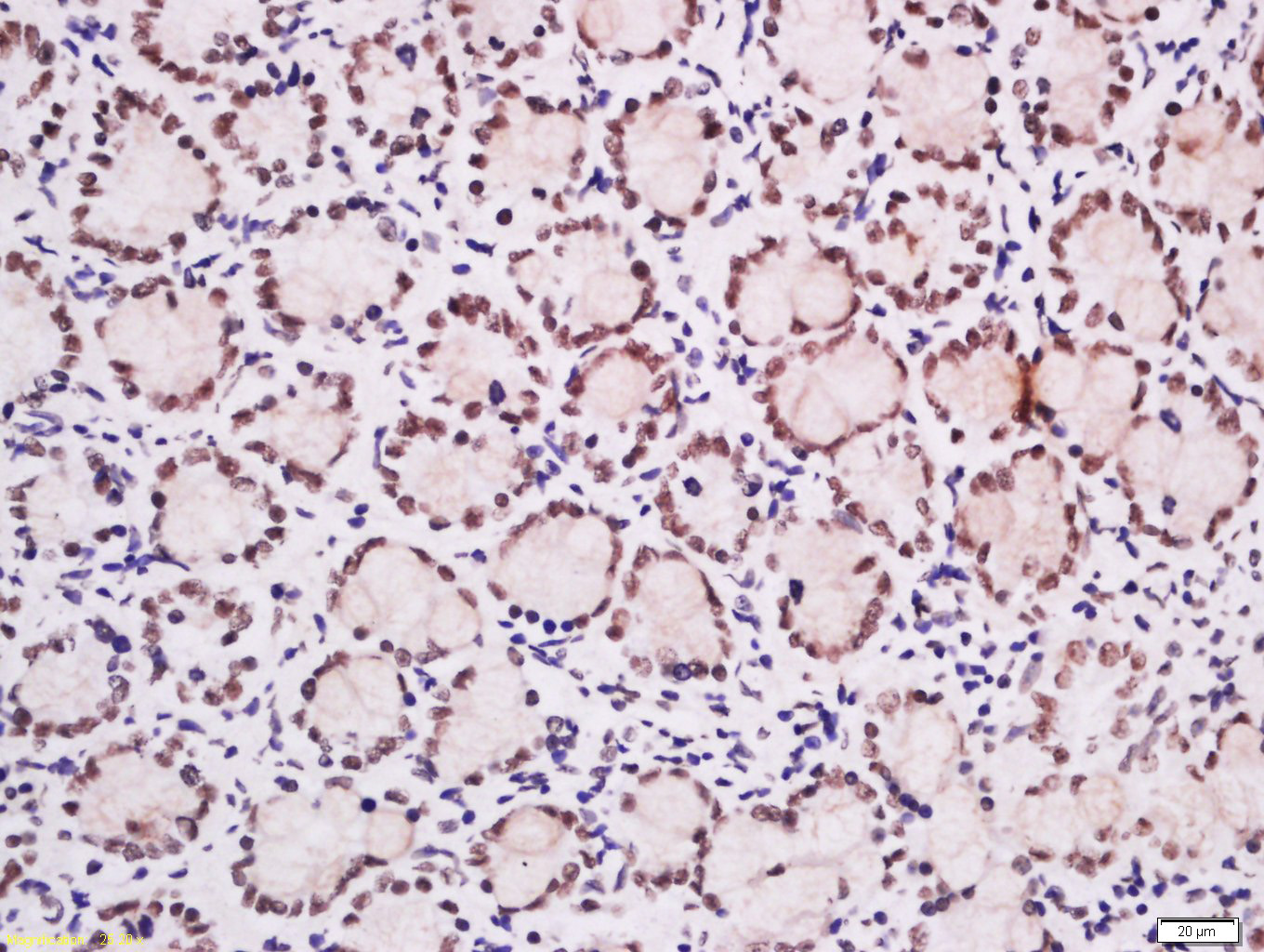 Paraformaldehyde-fixed, paraffin embedded Mouse intestine; Antigen retrieval by boiling in sodium citrate buffer (pH6.0) for 15min; Block endogenous peroxidase by 3% hydrogen peroxide for 20 minutes; Blocking buffer (normal goat serum) at 37°C for 30min; Antibody incubation with Ubiquitously expressed transcript Polyclonal Antibody, Unconjugated (bs-6749R) at 1:200 overnight at 4°C, DAB staining. Paraformaldehyde-fixed, paraffin embedded Mouse intestine; Antigen retrieval by boiling in sodium citrate buffer (pH6.0) for 15min; Block endogenous peroxidase by 3% hydrogen peroxide for 20 minutes; Blocking buffer (normal goat serum) at 37°C for 30min; Antibody incubation with Ubiquitously expressed transcript Polyclonal Antibody, Unconjugated (bs-6749R) at 1:200 overnight at 4°C, DAB staining.