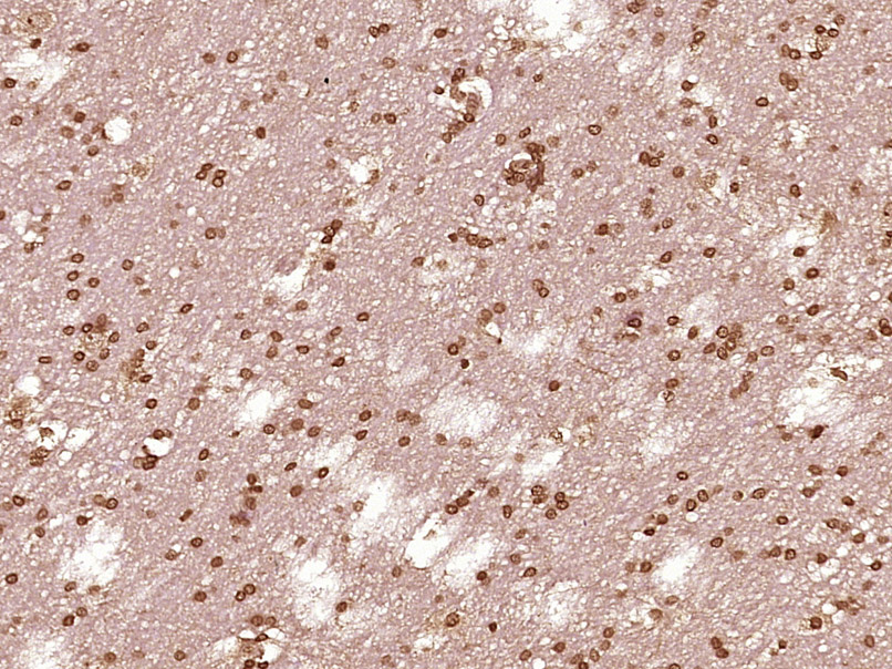 Paraformaldehyde-fixed, paraffin embedded Human brain glioma; Antigen retrieval by boiling in sodium citrate buffer (pH6.0) for 15min; Block endogenous peroxidase by 3% hydrogen peroxide for 20 minutes; Blocking buffer (normal goat serum) at 37°C for 30min; Antibody incubation with STAT1 p84+p91 Polyclonal Antibody, Unconjugated (bs-9584R) at 1:400 overnight at 4°C, DAB staining.