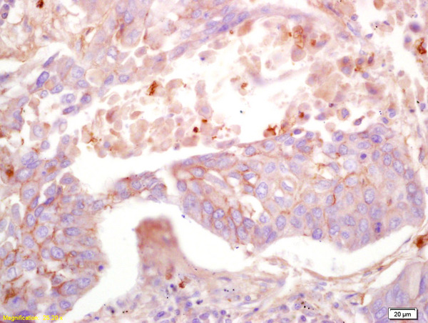 Formalin-fixed and paraffin embedded human lung carcinoma labeled with Anti-MAS1L Polyclonal Antibody, Unconjugated (bs-5926R) at 1:200 followed by conjugation to the secondary antibody and DAB staining. Formalin-fixed and paraffin embedded human lung carcinoma labeled with Anti-MAS1L Polyclonal Antibody, Unconjugated (bs-5926R) at 1:200 followed by conjugation to the secondary antibody and DAB staining.