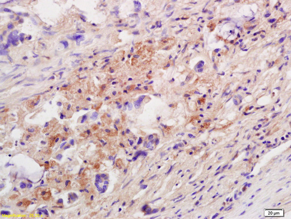 Formalin-fixed and paraffin embedded human colon carcinoma labeled with Anti-IL-10 Polyclonal Antibody, Unconjugated (bs-6761R) at 1:200 followed by conjugation to the secondary antibody and DAB staining.