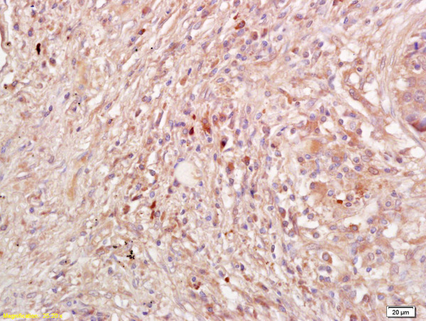 Formalin-fixed and paraffin embedded human lung carcinoma labeled with Anti-IL-10 Polyclonal Antibody, Unconjugated (bs-6761R) at 1:200 followed by conjugation to the secondary antibody and DAB staining.