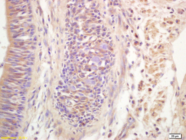 Formalin-fixed and paraffin embedded human lung carcinoma labeled with Anti-Ribonuclease Inhibitor Polyclonal Antibody, Unconjugated (bs-7518R) at 1:200 followed by conjugation to the secondary antibody and DAB staining.