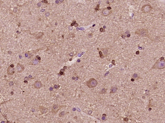Paraformaldehyde-fixed, paraffin embedded Human brain glioma; Antigen retrieval by boiling in sodium citrate buffer (pH6.0) for 15min; Block endogenous peroxidase by 3% hydrogen peroxide for 20 minutes; Blocking buffer (normal goat serum) at 37°C for 30min; Antibody incubation with MEX3D/RNF193 Polyclonal Antibody, Unconjugated (bs-18822R) at 1:400 overnight at 4°C, DAB staining.