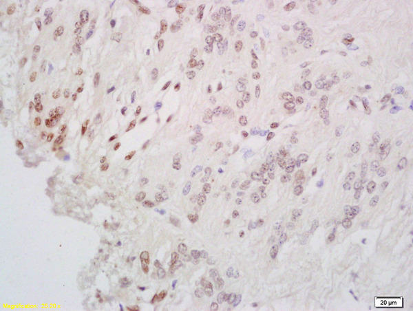 Formalin-fixed and paraffin embedded human cervial carcinoma labeled with Anti-CREB-1 Polyclonal Antibody, Unconjugated (bs-0035R) at 1:200 followed by conjugation to the secondary antibody and DAB staining.