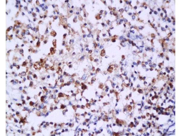 Formalin-fixed and paraffin embedded: human endometrium carcinoma labeled with Anti-Caspase-6 Polyclonal Antibody (bs-0151R), Unconjugated 1:200 followed by conjugation to the secondary antibody and DAB staining
