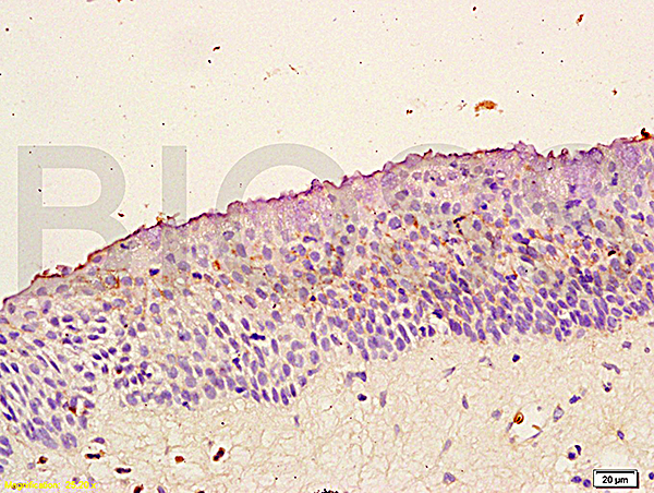 Formalin-fixed and paraffin embedded: human nasopharyngeal carcinoma labeled with Anti-Trk-B Polyclonal Antibody (bs-0175R), Unconjugated at 1:200 followed by conjugation to the secondary antibody and DAB staining