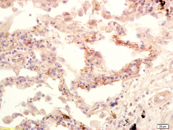Formalin-fixed and paraffin embedded human lung carcinoma labeled with Anti-GPS1/CSN1 Polyclonal Antibody, Unconjugated (bs-9126R) at 1:200 followed by conjugation to the secondary antibody and DAB staining.