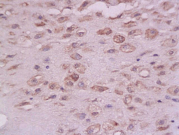 Formalin-fixed and paraffin embedded: human endometrium tissue labeled with Anti-PTP-1B Polyclonal Antibody (bs-0182R), Unconjugated  at 1:200 followed by conjugation to the secondary antibody and DAB staining