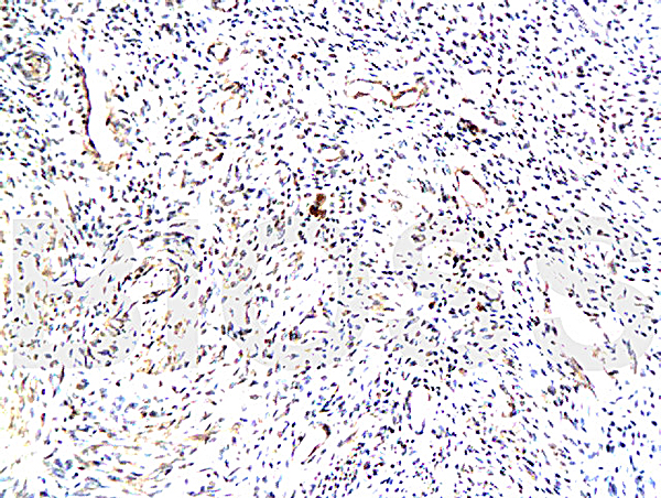 Formalin-fixed and paraffin embedded: human endometrium Anti-TrK-A\/NTRK1 Polyclonal Antibody (bs-0193R), Unconjugated at 1:200 followed by conjugation to the secondary antibody and DAB staining