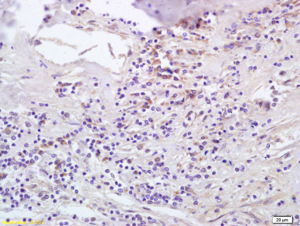 Formalin-fixed and paraffin embedded human lung carcinoma labeled with Anti-CCL5\/RANTES Polyclonal Antibody, Unconjugated (bs-1324R) at 1:200 followed by conjugation to the secondary antibody and DAB staining.