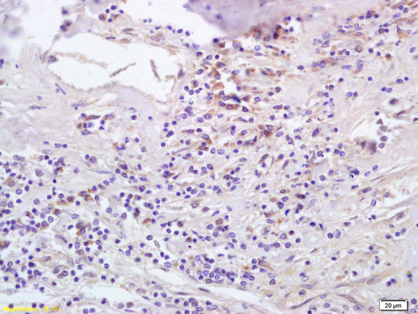 Formalin-fixed and paraffin embedded human lung carcinoma labeled with Anti-CCL5/RANTES Polyclonal Antibody, Unconjugated (bs-1324R) at 1:200 followed by conjugation to the secondary antibody and DAB staining.