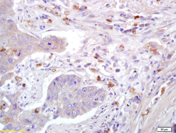 Formalin-fixed and paraffin embedded human lung carcinoma labeled with Anti-Caveolin-1 Polyclonal Antibody, Unconjugated (bs-1453R) at 1:200 followed by conjugation to the secondary antibody and DAB staining.