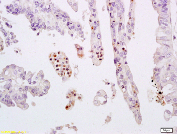 Formalin-fixed and paraffin embedded human breast carcinoma labeled with Anti-phospho-STAT3 (Tyr705) Polyclonal Antibody, Unconjugated (bs-1658R) at 1:200 followed by conjugation to the secondary antibody and DAB staining.