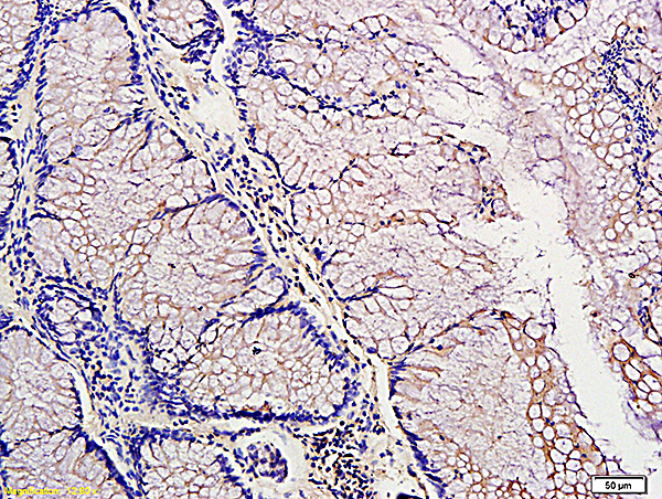 Formalin-fixed and paraffin embedded: human colon tubular adenocarcinoma labeled with Anti-PDGF-A  Polyclonal Antibody (bs-0196R), Unconjugated at 1:300, followed by conjugation to the secondary antibody and DAB staining