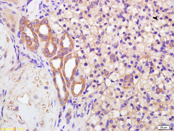 Formalin-fixed and paraffin embedded human kidney carcinoma labeled with Anti-Polycystin 2 Polyclonal Antibody, Unconjugated (bs-2158R) at 1:200 followed by conjugation to the secondary antibody and DAB staining.