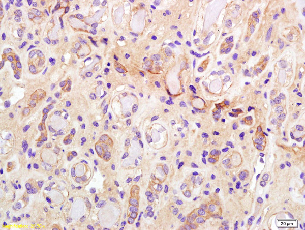 Formalin-fixed and paraffin embedded human kidney carcinoma labeled with Anti-phospho-IRS-1(Ser307) Polyclonal Antibody, Unconjugated (bs-2736R) at 1:200 followed by conjugation to the secondary antibody and DAB staining.