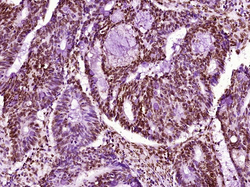 Paraformaldehyde-fixed, paraffin embedded Human colon cancer; Antigen retrieval by boiling in sodium citrate buffer (pH6.0) for 15min; Block endogenous peroxidase by 3% hydrogen peroxide for 20 minutes; Blocking buffer (normal goat serum) at 37°C for 30min; Antibody incubation with Histone H3 (di methyl K79) Monoclonal Antibody, Unconjugated (bsm-33093M) at 1:400 overnight at 4°C, DAB staining.