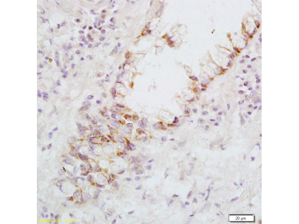Formalin-fixed and paraffin embedded: human rectal carcinoma labeled with Anti-FasL Polyclonal Antibody, Unconjugated (bs-0216R) at 1:200, followed by conjugation to the secondary antibody and DAB staining