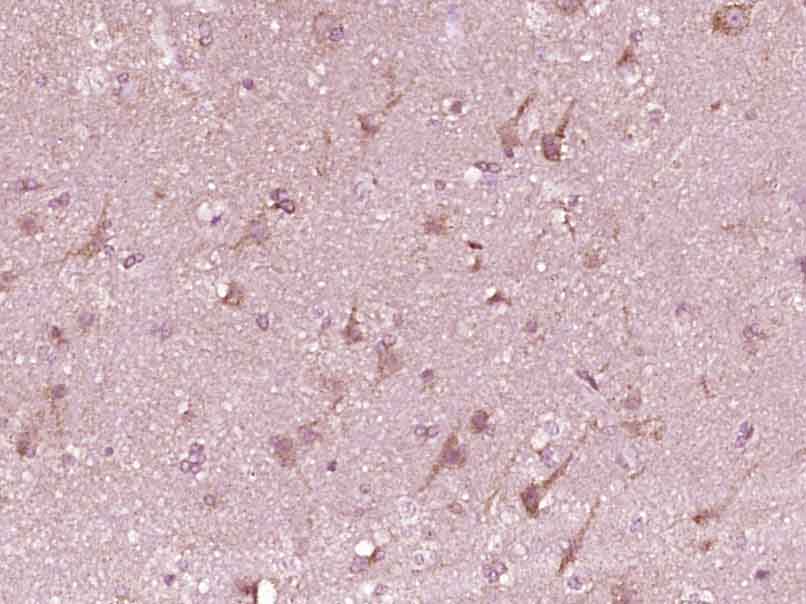 Paraformaldehyde-fixed, paraffin embedded Human brain glioma; Antigen retrieval by boiling in sodium citrate buffer (pH6.0) for 15min; Block endogenous peroxidase by 3% hydrogen peroxide for 20 minutes; Blocking buffer (normal goat serum) at 37°C for 30min; Antibody incubation with BMAL1 Polyclonal Antibody, Unconjugated (bs-3750R) at 1:400 overnight at 4°C, DAB staining.