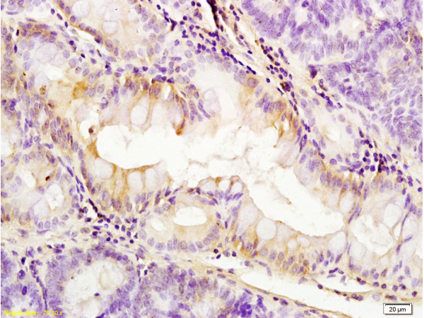 Formalin-fixed and paraffin embedded: rat colitis tissue labeled with Anti-PDGFRA Polyclonal Antibody, Unconjugated (bs-0231R) at 1:200, followed by conjugation to the secondary antibody and DAB staining