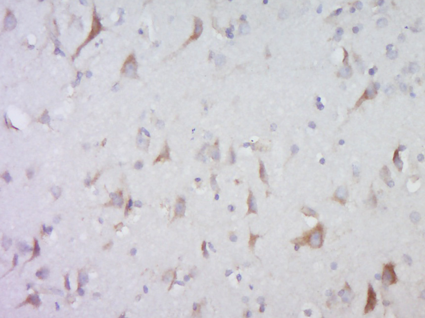 Paraformaldehyde-fixed, paraffin embedded Human brain glioma; Antigen retrieval by boiling in sodium citrate buffer (pH6.0) for 15min; Block endogenous peroxidase by 3% hydrogen peroxide for 20 minutes; Blocking buffer normal goat serum at 37°C for 30min; Antibody incubation with testis antigen 1B Polyclonal Antibody, Unconjugated bs-4501R at 1:400 overnight at 4°C, followed by a conjugated secondary antibody and DAB staining.