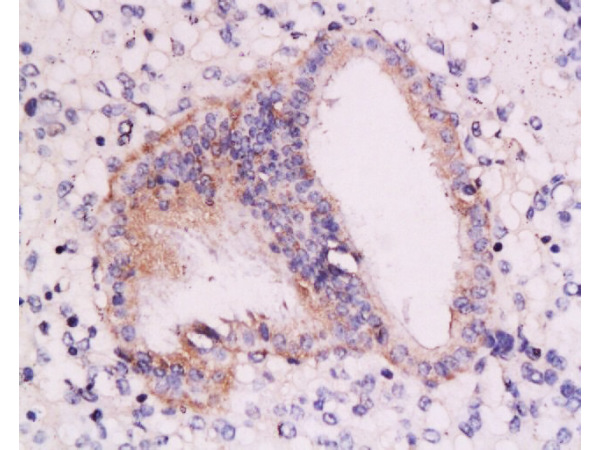 Formalin-fixed and paraffin embedded: human endometrium tissue labeled with Anti-RAR-alpha Polyclonal Antibody, Unconjugated(bs-0251R) at 1:200, followed by conjugation to the secondary antibody and DAB staining