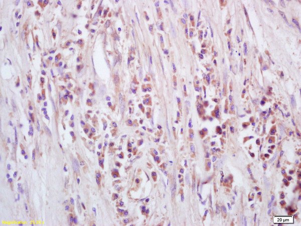 Formalin-fixed and paraffin embedded human lung carcinoma labeled with Anti-GTSE-1 Polyclonal Antibody, Unconjugated (bs-2516R) at 1:200, followed by conjugation to the secondary antibody and DAB staining