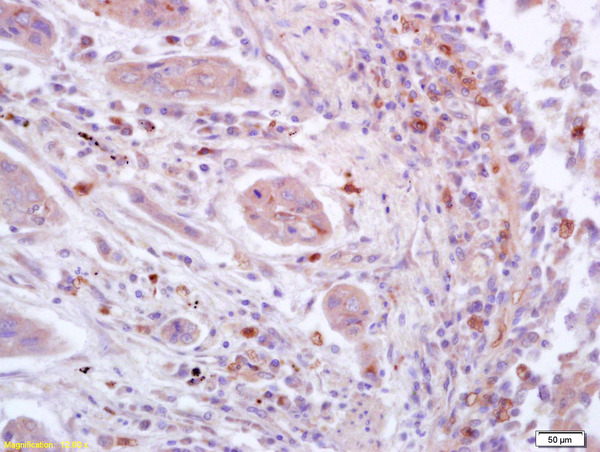 Formalin-fixed and paraffin embedded human lung carcinoma labeled with Anti-phospho-STAT3 (Ser727) Polyclonal Antibody, Unconjugated (bs-3429R) at 1:200 followed by conjugation to the secondary antibody and DAB staining.