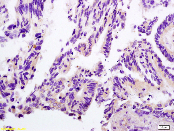 Formalin-fixed and paraffin embedded human rectal carcinoma labeled with Anti-LDHC/Cancer,testis antigen 32 Polyclonal Antibody, Unconjugated (bs-3827R) at 1:200 followed by conjugation to the secondary antibody and DAB staining.