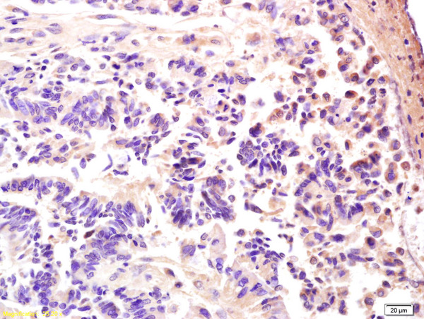 Formalin-fixed and paraffin embedded human rectal carcinoma labeled with Anti-AMPK gamma 3/PRKAG3 Polyclonal Antibody, Unconjugated (bs-3968R) at 1:200 followed by conjugation to the secondary antibody and DAB staining.
