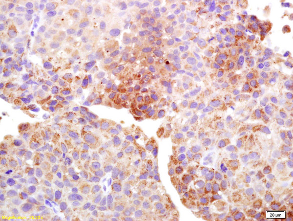 Formalin-fixed and paraffin embedded human bladder carcinoma labeled with Anti-Cancer/testis antigen 1B/1A Polyclonal Antibody, Unconjugated (bs-4501R) at 1:200 followed by conjugation to the secondary antibody and DAB staining.