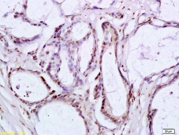 Formalin-fixed and paraffin embedded human colon carcinoma labeled with Anti-BRLF1 Polyclonal Antibody, Unconjugated (bs-4542R) at 1:200 followed by conjugation to the secondary antibody and DAB staining.