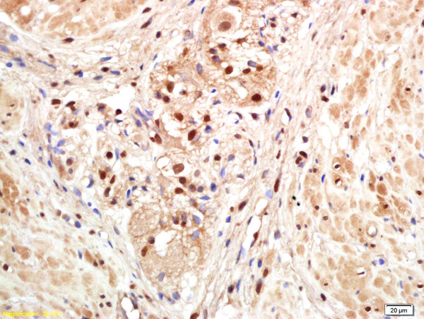 Formalin-fixed and paraffin embedded human gastric carcinoma labeled with Anti-PAPOG Polyclonal Antibody, Unconjugated (bs-4968R) at 1:200 followed by conjugation to the secondary antibody and DAB staining. Formalin-fixed and paraffin embedded human gastric carcinoma labeled with Anti-PAPOG Polyclonal Antibody, Unconjugated (bs-4968R) at 1:200 followed by conjugation to the secondary antibody and DAB staining.