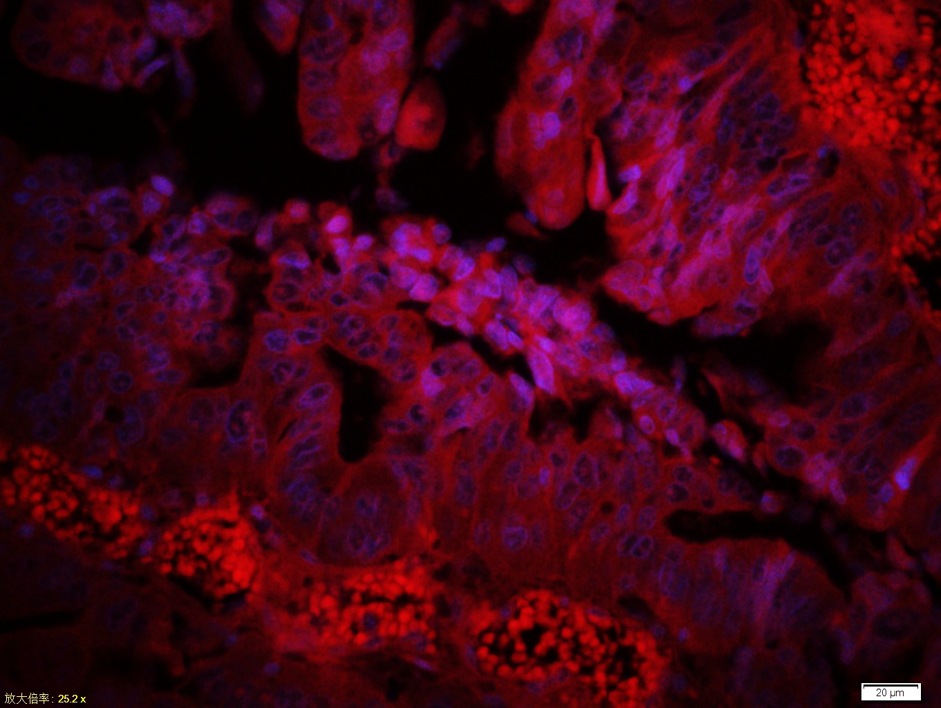 Paraformaldehyde-fixed, paraffin embedded Human rectal cancer; Antigen retrieval by boiling in sodium citrate buffer (pH6.0) for 15min; Blocking buffer (normal goat serum) at 37°C for 30min; Incubation: Anti-Complement fragment 3c Antibody, conjugated (bs-4877R-CY3) at 1:400 overnight at 4°C; DAPI was used to stain the cell nuclei.