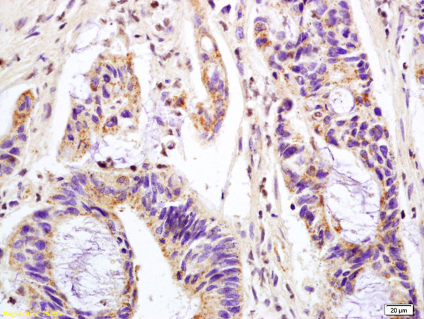 Formalin-fixed and paraffin embedded human colon carcinoma labeled with Anti-phospho-MAPK11(Thr180+Tyr182) Polyclonal Antibody, Unconjugated (bs-5506R) at 1:200 followed by conjugation to the secondary antibody and DAB staining.