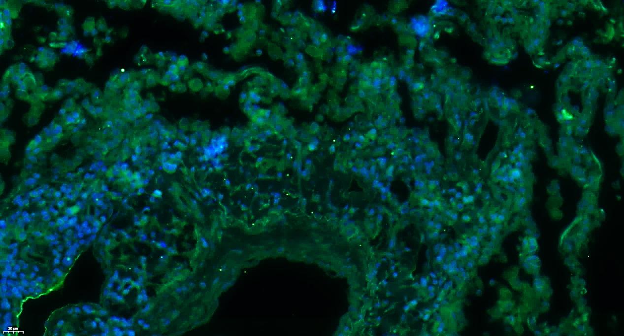 Paraformaldehyde-fixed, paraffin embedded Human lung cancer; Antigen retrieval by boiling in sodium citrate buffer (pH6.0) for 15min; Blocking buffer (normal goat serum) at 37°C for 30min; Antibody incubation with NAV2 Polyclonal Antibody, Unconjugated (bs-11892R) at 1:400 overnight at 4°C, followed by a conjugated Goat Anti-Rabbit IgG antibody (bs-0295G-FITC) for 90 minutes, and DAPI for nuclei staining.