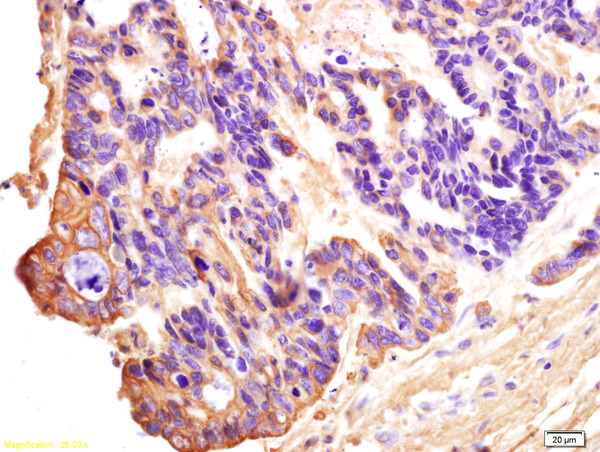 Formalin-fixed and paraffin embedded human rectal carcinoma labeled with Anti-DDX43/CT13 Polyclonal Antibody, Unconjugated (bs-6226R) at 1:200 followed by conjugation to the secondary antibody and DAB staining.