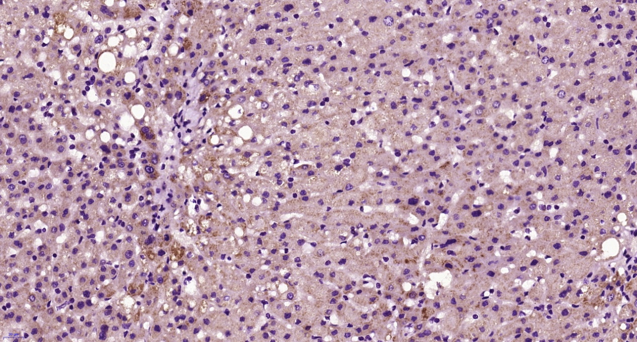 Paraformaldehyde-fixed, paraffin embedded Human liver; Antigen retrieval by boiling in sodium citrate buffer (pH6.0) for 15min; Block endogenous peroxidase by 3% hydrogen peroxide for 20 minutes; Blocking buffer (normal goat serum) at 37°C for 30min; Antibody incubation with HHEX Polyclonal Antibody, Unconjugated (bs-6600R) at 1:400 overnight at 4°C, followed by secondary and DAB staining.