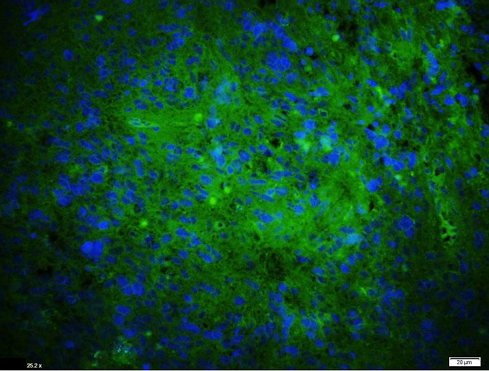 Paraformaldehyde-fixed, paraffin embedded Human glioblastoma; Antigen retrieval by boiling in sodium citrate buffer (pH6.0) for 15min; Blocking buffer (normal goat serum) at 37°C for 30min; Antibody incubation with LILRB2 Polyclonal Antibody, Unconjugated (bs-7349R) at 1:400 overnight at 4°C, followed by a conjugated Goat Anti-Rabbit IgG antibody (bs-0295G-FITC) for 90 minutes, and DAPI for nuclei staining. Paraformaldehyde-fixed, paraffin embedded Human glioblastoma; Antigen retrieval by boiling in sodium citrate buffer (pH6.0) for 15min; Blocking buffer (normal goat serum) at 37°C for 30min; Antibody incubation with LILRB2 Polyclonal Antibody, Unconjugated (bs-7349R) at 1:400 overnight at 4°C, followed by a conjugated Goat Anti-Rabbit IgG antibody (bs-0295G-FITC) for 90 minutes, and DAPI for nuclei staining.