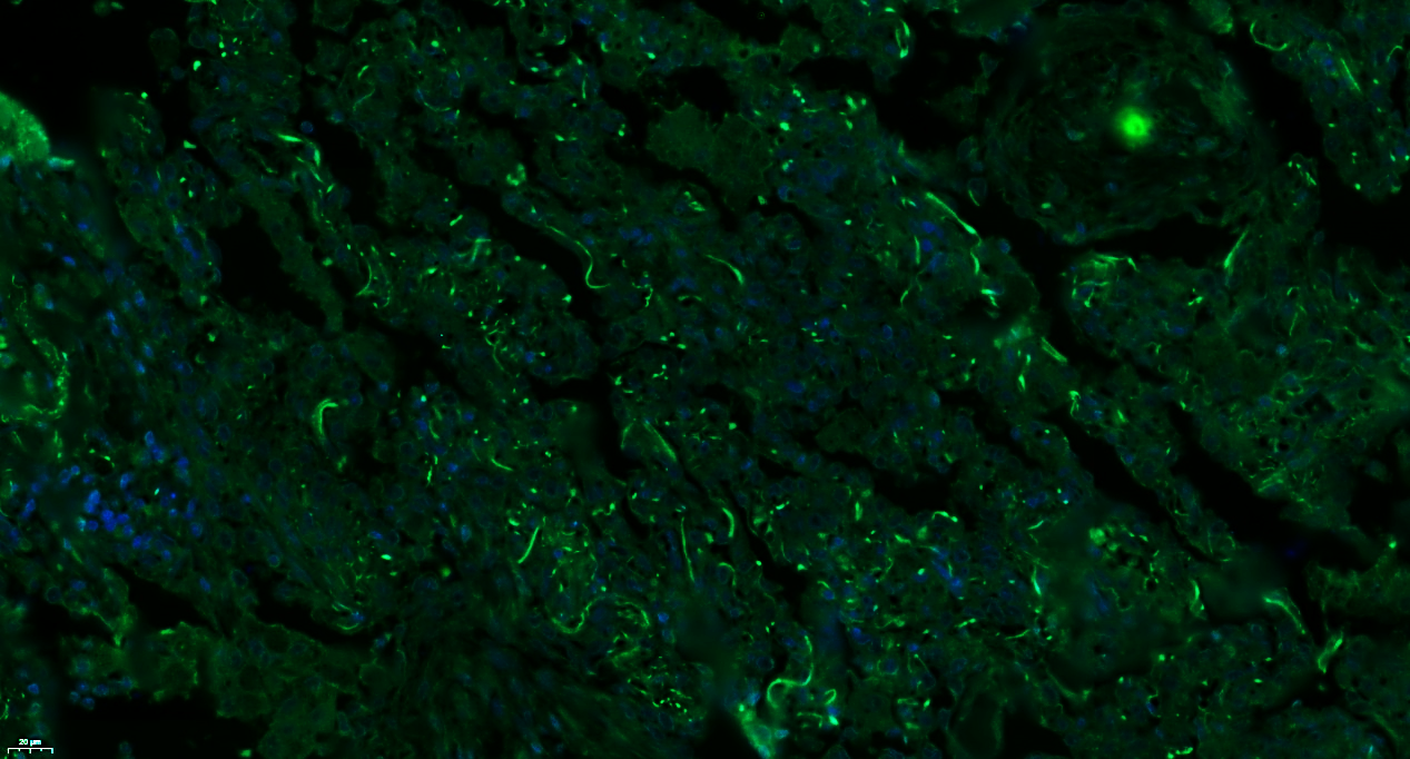 Paraformaldehyde-fixed, paraffin embedded Human lung cancer; Antigen retrieval by boiling in sodium citrate buffer (pH6.0) for 15min; Blocking buffer (normal goat serum) at 37°C for 30min; Antibody incubation with MASP1/MASP3 Polyclonal Antibody, Unconjugated (bs-1723R) at 1:100 overnight at 4°C, followed by a conjugated Goat Anti-Rabbit IgG antibody (bs-0295G-FITC) for 90 minutes, and DAPI for nuclei staining.