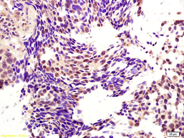 Formalin-fixed and paraffin embedded human lung carcinoma labeled with Anti-CENPH Polyclonal Antibody, Unconjugated (bs-6519R) at 1:200 followed by conjugation to the secondary antibody and DAB staining.